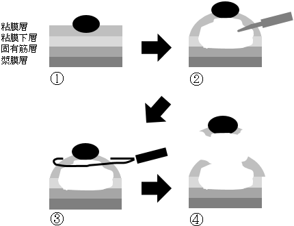 大腸内視鏡切除イメージ